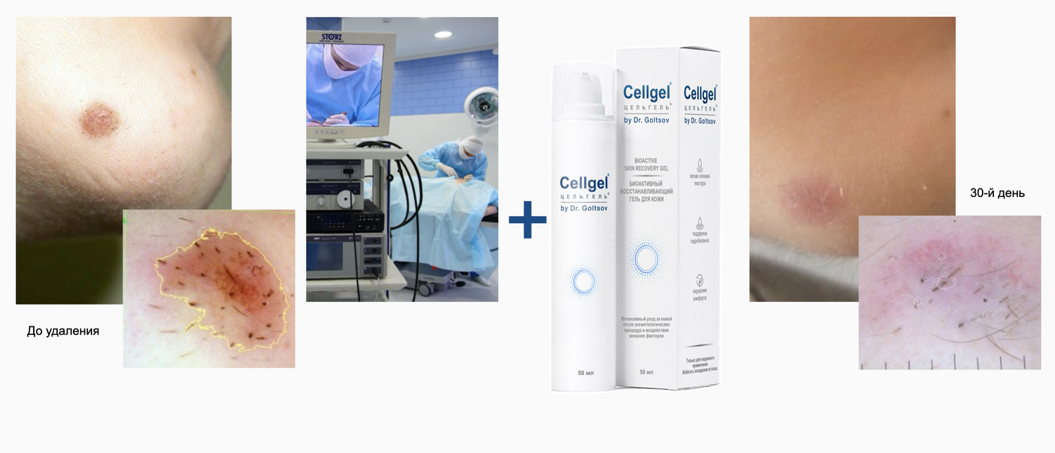 Cellgel® (Цельгель®)