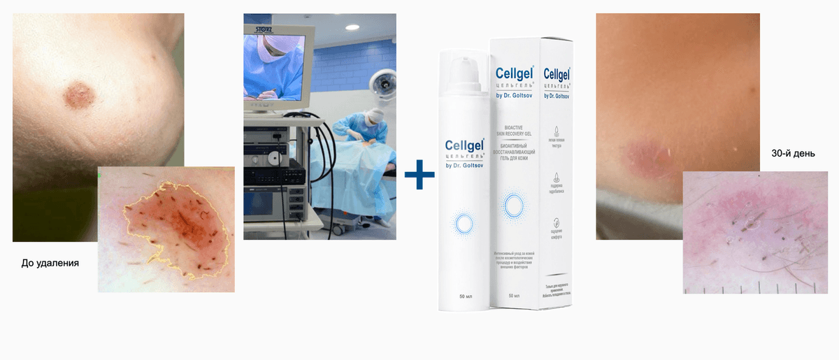 Восстановление  с Cellgel после удаления новообразований